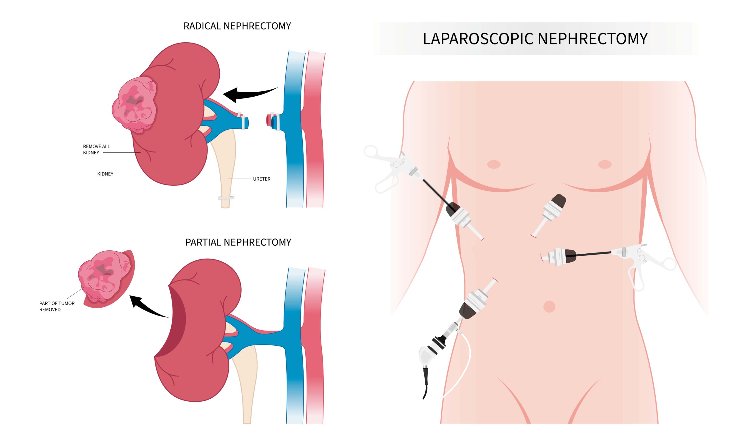 Urólogo, Cirugía renal, laparoscopia